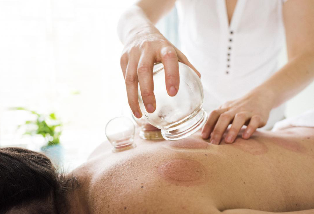 Cupping - Thai Royal Orchid Massage